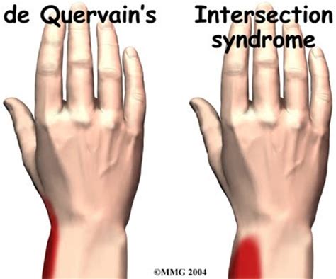 3XXA became effective on October 1, 2023. . Bilateral wrist pain icd 10